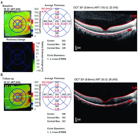 thickness measurement of retina|retinal thickness map.